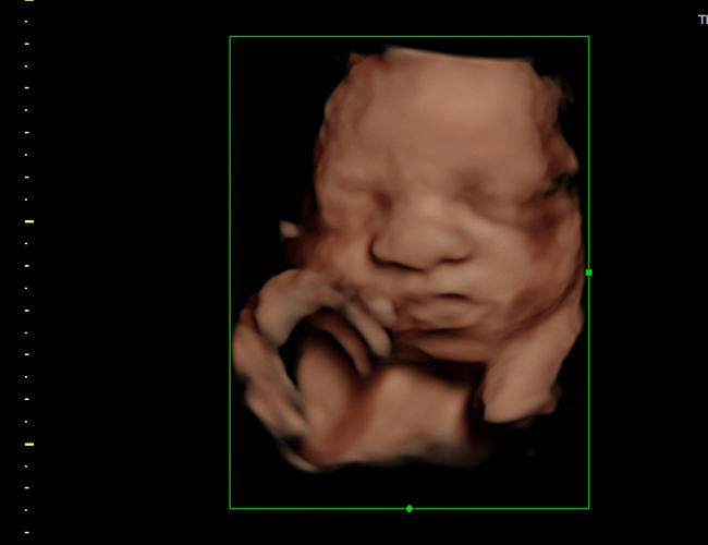 3D ultrasound image at 29 weeks